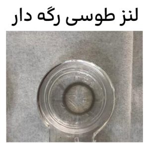 لنز چشم طوسی رگه دار