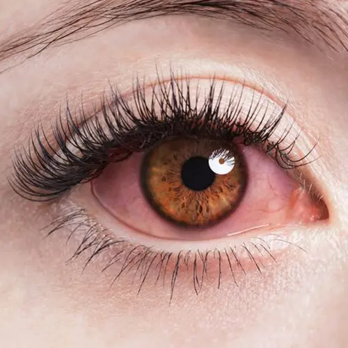 عدم توجه به ناراحتی های چشمی