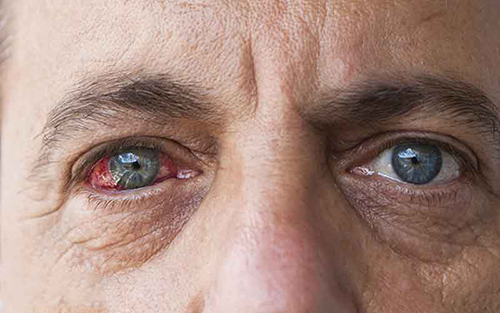 دیابت و بیماری های چشمی